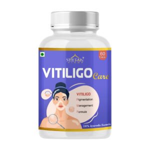 vitiligo care